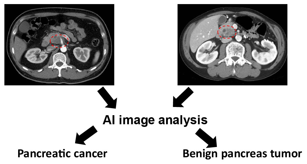 人工智能輔助影像處理提升胰臟 腫瘤之偵測與鑑定