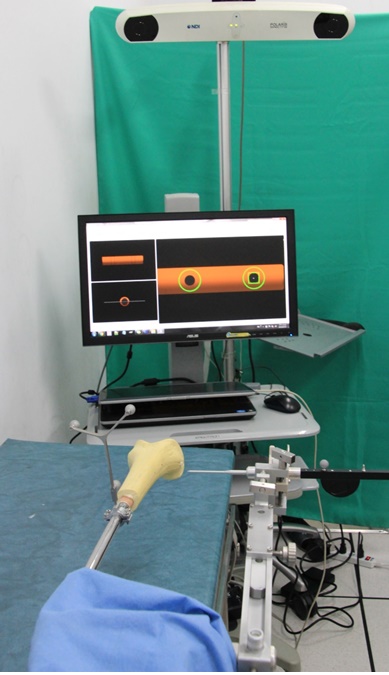 Computer assisted surgical navigation system for femoral fracture reconstruction
