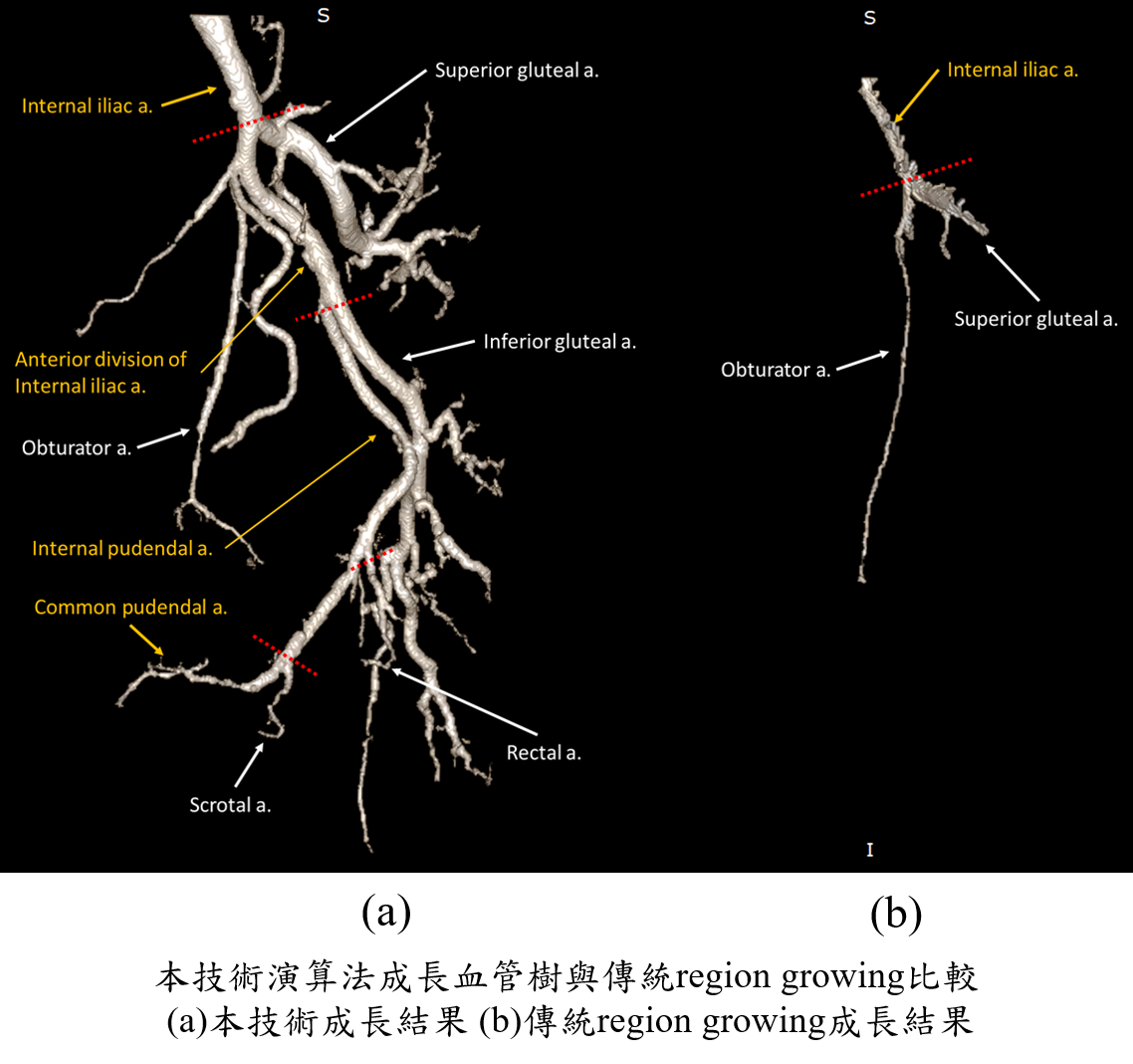 多切面電腦斷層之血管攝影電腦輔助診斷系統：骨盆腔動脈 血管重建和狹窄偵測