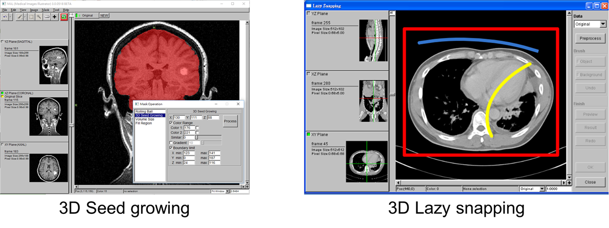 個人化的醫療影像處理與虛擬實境 MiiL& VVViewer