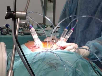remote controlled minimally invasive osteosynthesis bone cement injection system