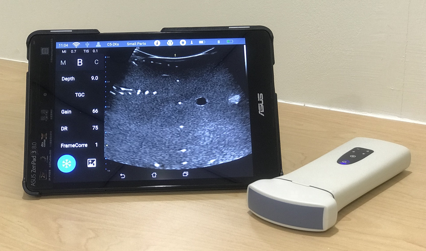 FattyTouch: an ultrasound system dedicated to fatty liver screening