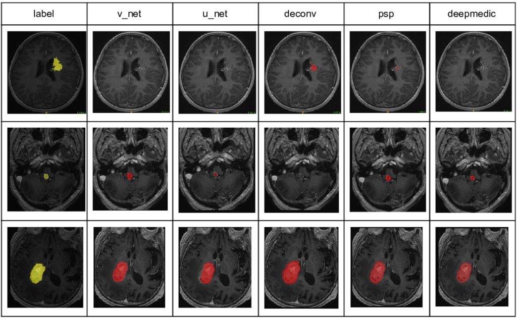 Automated segmentation of brain tumors