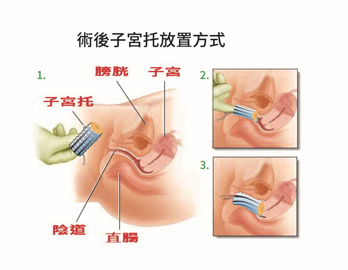 Vaginal stanch pessary