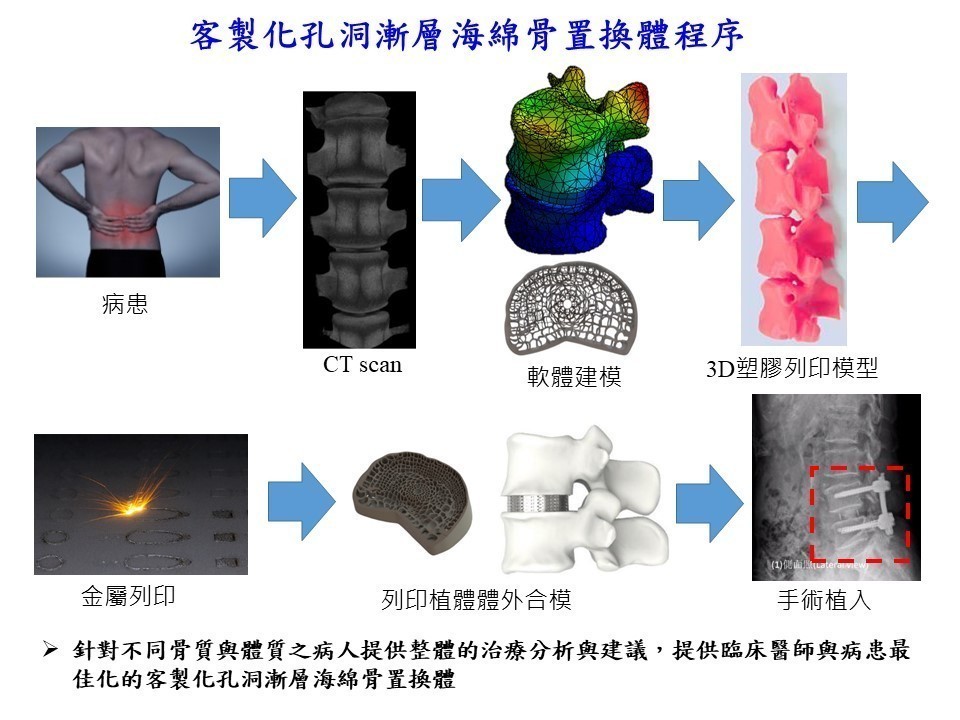 Development of 3D-print porous gradient glassy-metal for cancellous bone prosthesis