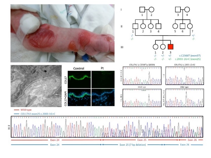 The application of next-generation sequencing in the genetic diagnosis of epidermolysis bullosathe establishment of multidisciplinary clinic for epidermolysis bullosa