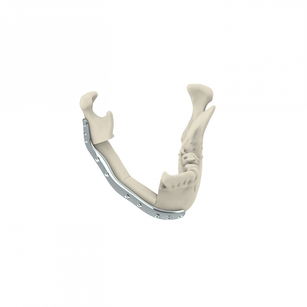 METICULY: Patient-specific Mandibular Plate for Mandibular Reconstruction Surgery