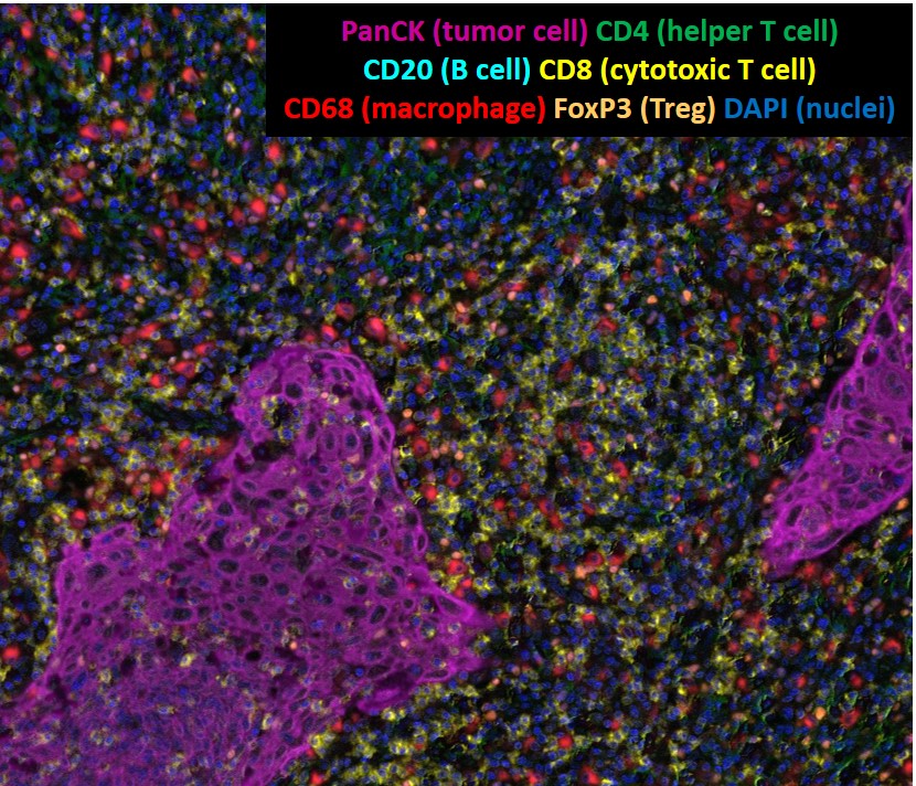 多重免疫組織螢光染色: 腫瘤浸潤免疫細胞族群及距離分析