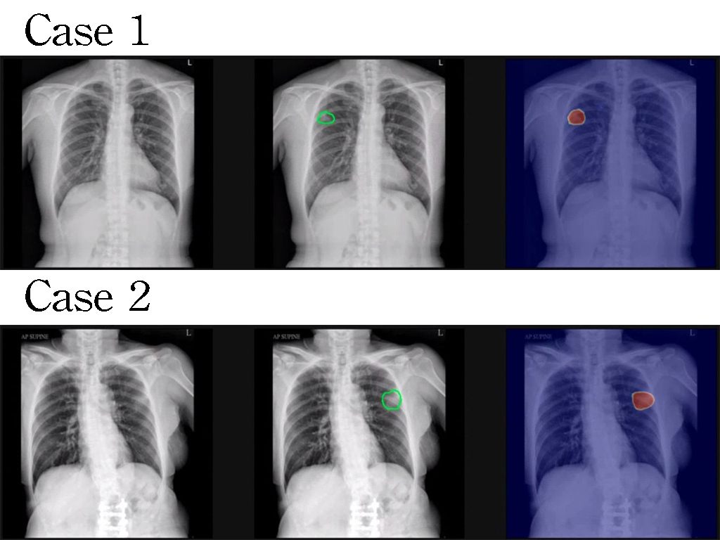 運用人工智慧技術建構胸腔X光影像偵測早期肺癌病灶模型