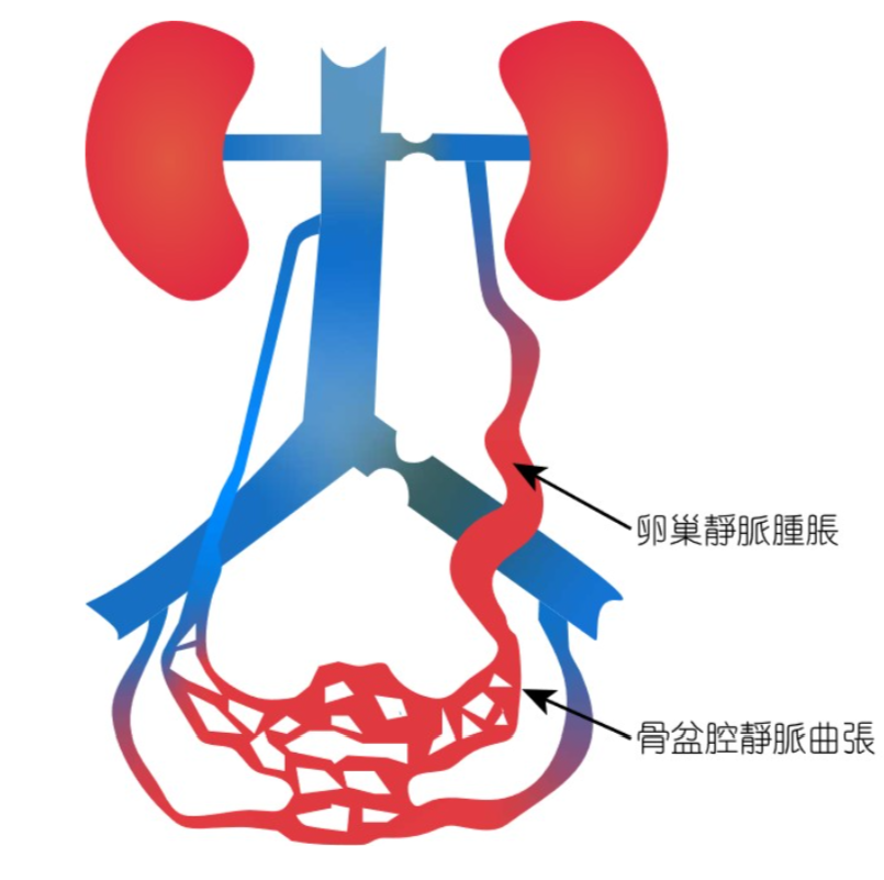 骨盆靜脈鬱血之非對比磁振造影診斷與血流分析系統