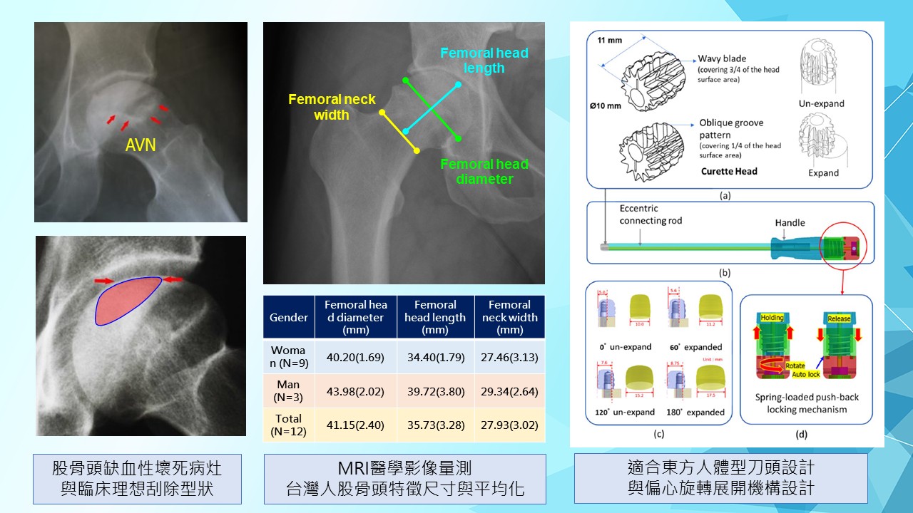 智慧型精準可調式多段差偏心旋轉股骨頭清創器械